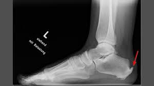 Chronische Insertionstendopathie Ogam Orthopadie