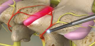 Image result for Radiofrequency Surgery