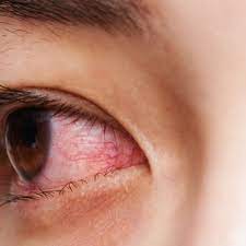 Gangguan mata yang samar juga bisa tanda penyakit yang serius pada mata. Bahaya Pterygium Selaput Putih Pada Bola Mata