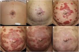 Image result for Pemphigus