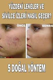 Yuzdeki Lekeler Ve Sivilce Izleri Nasil Gecer Evde Nasil Yapilir Sivilce Izi Cilt Bakimi Yuzler