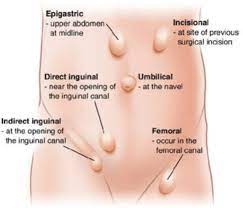 Hernia Surgery Open Hernia Repair Dr Andrew Kiyingi