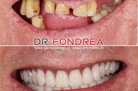 Cât costă un implant dentar în funcție de experiența stomatologului. Preturi Dentist Arhive Dr Bogdan Fondrea