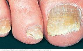 Look for signs of toenail injury. 2mtbzzcdsy4gnm