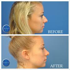 Rhinoplasty Plastic Surgery Nose Job Richmond Vienna Virginia Nose Plastic Surgery Rhinoplasty Rhinoplasty Nose Jobs