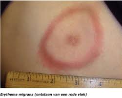 Een tekenbeet merk je nauwelijks, maar hij kan grote gevolgen hebben. De Ziekte Van Lyme Een Snelgroeiend Probleem