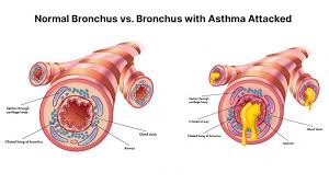 Questioning whether you can vape cbd oil depends on what you're referring to. Cbd Oil For Asthma Can It Help How To Use