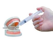 Amazon.com: Wisdom Teeth Syringe, 50 Pack Dental Irrigation Curved Syringes  for Dental Care Liquid Oral Tonsil Stone TMJ Chin Pain Relief Recovery ...