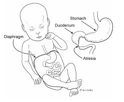 Image result for Intestinal Atresia