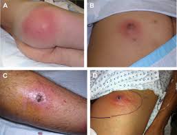 Image result for Skin Abscess