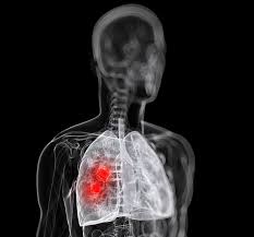 There can be many different reasons for having a persistent cough; Osimertinib Improves Symptoms In Advanced Lung Cancer Patients