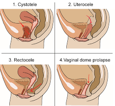 Tipos De Prolapso Cual Es El Tratamiento Adecuado En Fisioterapia Virginia Moreno Fisioterapia