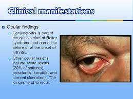 Reiter's syndrome, also known as reactive arthritis, is the classic triad of conjunctivitis, urethritis, and arthritis occurring after an infection, particularly those in the urogenital or gastrointestinal tract. Reactive Arthritis Ppt Download