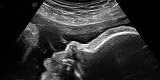 It also helps you to value. Week 36 Ultrasound What It Would Look Like Parents