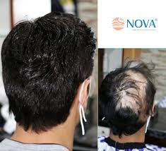 Nova Sac Sistemleri Novafolligraft Twitter