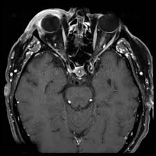 Image result for Optic Neuritis
