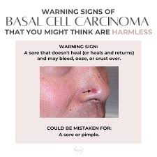 Image result for skin cancer on nose pimple
