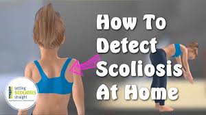 How To Detect Scoliosis At Home Explained Under 1 Minute Youtube