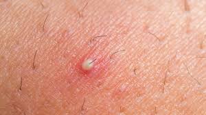 It's been around for a long time, and its purpose is to remove hair permanently. What Causes Ingrown Hairs And What Treatments Are There