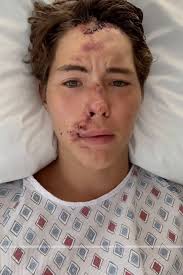 TikTok Star Caleb Coffee in ICU After Falling Off Cliff onto Lava Rocks