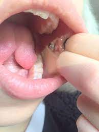Cheek Piercings Are Often Difficult To Heal Nopull Piercing Disc Is Safe And Comfortable To Wear Inside Or Outside The Di Cheek Piercings Piercing Piercings