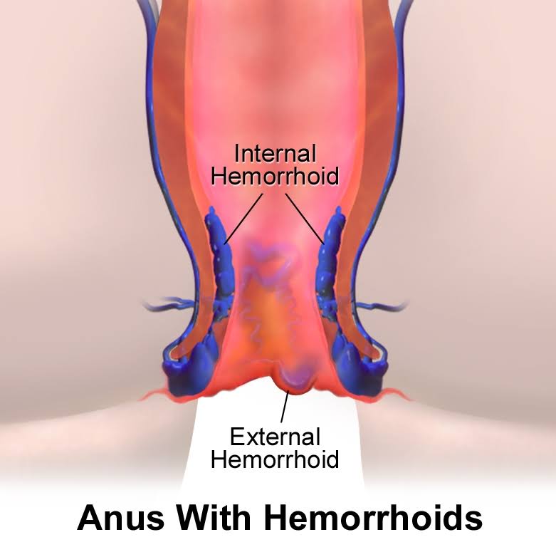 Hemorrhoids surgery product image