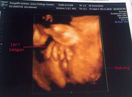 Gambe bollenti di notte cause. Jenis Kelamin Hasil Gambar Usg Bayi Laki Laki