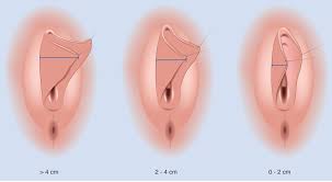 Inwiefern eine absaugung des venushügels. Schamlippenverkleinerung Mira Beau Gender Esthetics
