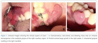 Image result for granuloma gum disease
