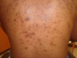 Image result for Postinflammatory Hypopigmentation