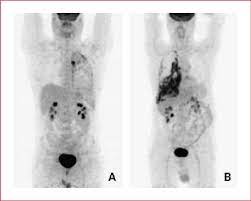Careful selection of malignant pleural mesothelioma (mpm) patients for curative treatment is of highest importance, as the multimodal . Fdg Pet Images Of Two Different Patients With Mesothelioma With Download Scientific Diagram