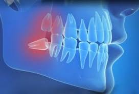 How bad is the infection when your. Wisdom Teeth Symptoms Common Signs You Need Your Wisdom Teeth Removed Dental Town Dc Cosmetic Dentists