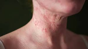 Image result for Atopic eczema atopic dermatitis