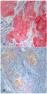 2 the discovery that congo red stains amyloid. Https Ispub Com Ijpa 17 1 25060