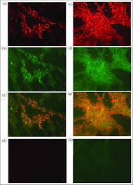 On the other hand, bleeding from colon cancer is typically described as darker in appearance. Two Colour Immunofluorescence Staining Of Primary Colon Cancer Tissue Download Scientific Diagram