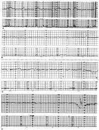 Image result for Non-Stress Test
