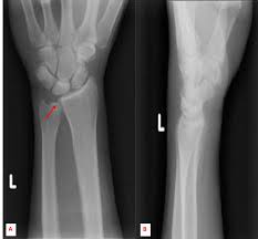 The kienbock disease radiographic guided treatment versus arthroscopic guided treatment. Cureus Repetitive Microtrauma And Negative Ulnar Variance As Possible Culprits Of Avascular Necrosis Of The Lunate
