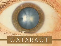 Check spelling or type a new query. Cataract Types Causes Symptoms Diagnosis And Treatment Boldsky Com