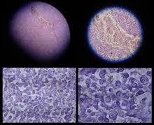 50 % aller mpm sind epitheloid. Mesothelioma Wikipedia