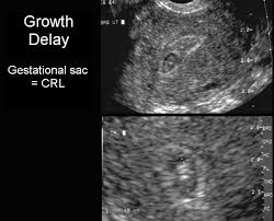 abnormalities in the size of the gestational sac