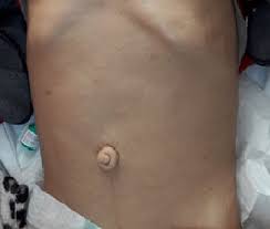 It is a type of lipodystophy disorder where the magnitude of fat loss determines the severity of metabolic complications. Oman Medical Journal Archive