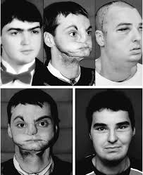 his whole upper jaw, excepting two front teeth, and most of his lower jaw  had been removed. All the remaining bone tissue of his body was slowly  disintegrating, and holes were actually