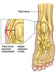 Tarsal Tunnel Syndrome