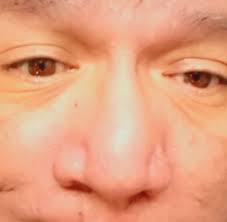 Question: Has anyone else experienced a change to the color of their  irises? While my eyes have been quite symptomatic, I certainly would not  have expected a change in color.