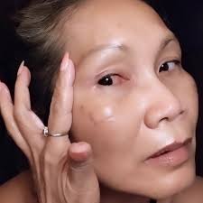 Inflammation of the capillries in the eye.