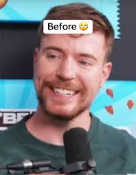 Mr Beast Fixed Teeth