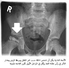 Both hips are affected in some children, usually at different times. Ù…Ø±Ø¶ Ø¨ÙŠØ±Ø«Ø² Ø¹ÙŠØ§Ø¯Ø© Ø¬Ø±Ø§Ø­Ø© Ø§Ù„Ø¹Ø¸Ø§Ù… ÙˆØ§Ù…Ø±Ø§Ø¶ Ø§Ù„Ù…ÙØ§ØµÙ„ Ø¯ Ø§ÙŠÙ‡Ø§Ø¨ Ø§Ù„ØµØ§ÙˆÙŠ ÙÙŠØ³Ø¨ÙˆÙƒ