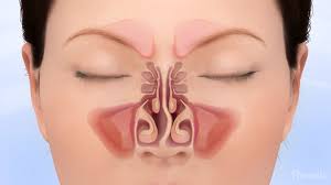 Therefore, to know your best options, it might be a good idea to discus the. Deviated Septum Dallas Ent