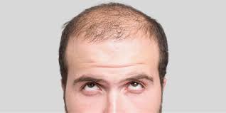 Merawat bau kepala yang kurang menyenangkan. Rambut Gugur Punca Jenis Dan Rawatan The Diagnosa