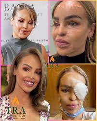 💔 Katie Piper's Brave New Chapter 😢 17 years after surviving a horrific  acid attack, Katie Piper is taking a powerful new step — revealing she's  about to receive an artificial eye